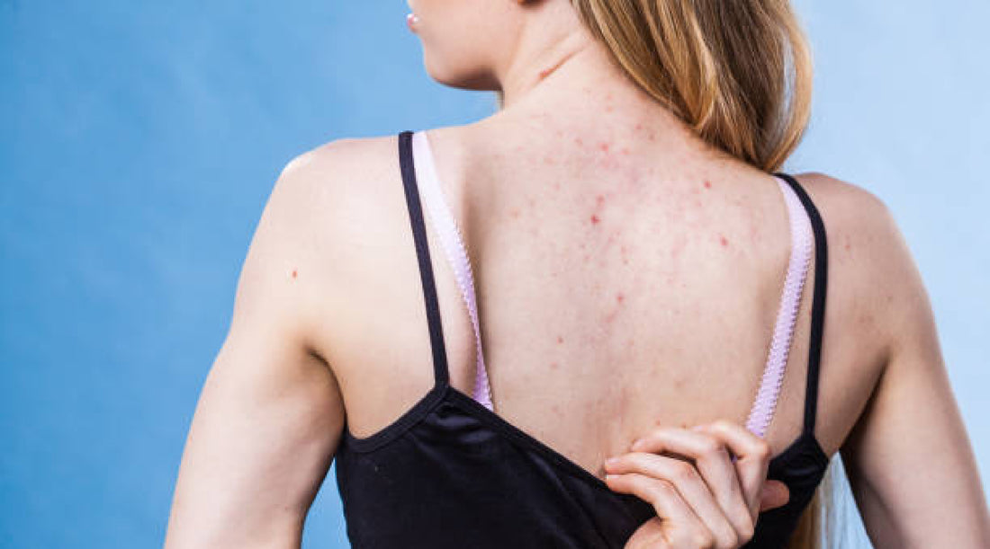 Beyond the Face: Treating Acne on Your Back, Chest, and Shoulders